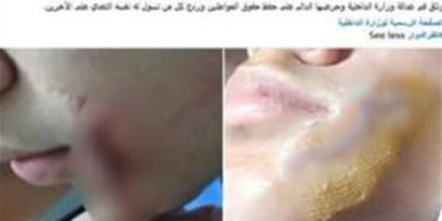 القبض على طالب تعدى على زميله بقطعة زجاج بالبحيرة - أقرأ 24