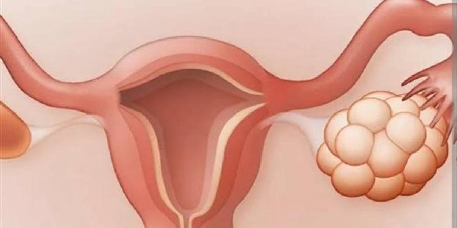 علاج فعال لتكيس المبياض - أقرأ 24