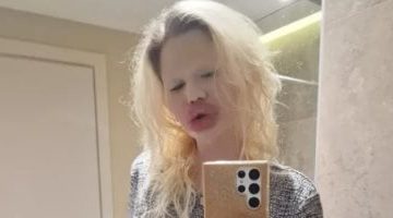 «تحول صادم» صاحبة الرقم القياسي لأكبر شفاه في العالم تكشف عن صورها قبل عمليات التجميل