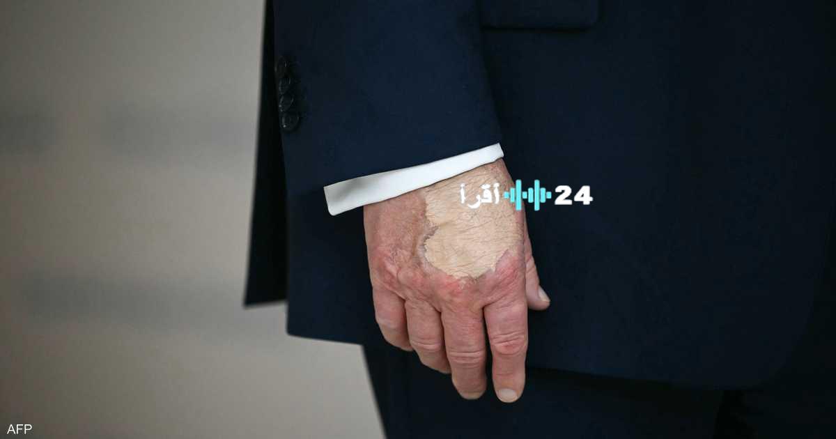 ترامب يخفي كدمة بيده بالمكياج يثير جدلا واسعا