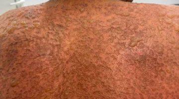 مستشفى المنصورة الدولي ينقذ مريضًا من مرض جلدي نادر