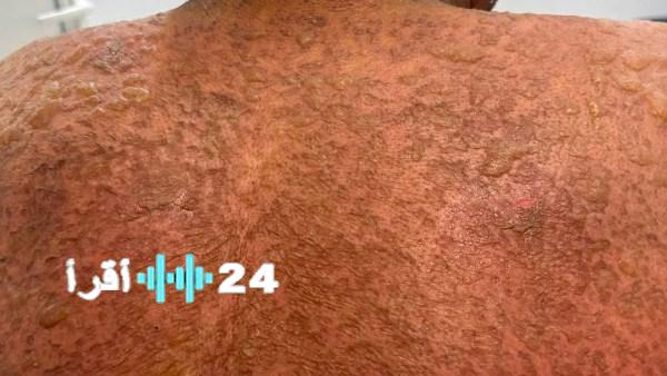 مستشفى المنصورة الدولي ينقذ مريضًا من مرض جلدي نادر