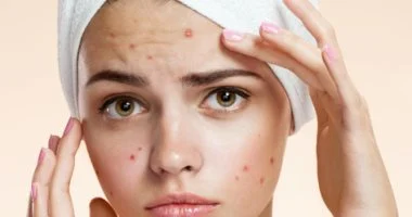 وداعًا لحب الشباب اكتشف الوصفات الطبيعية الفعالة بالليمون والعسل لبشرة نقية ومشرقة