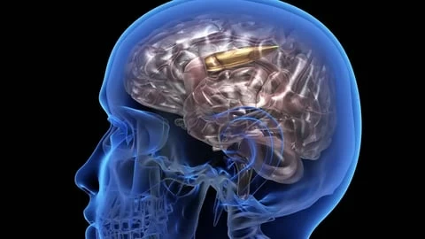 مصر.. رجُل يزور الطبيب بعد شعوره باضطراب في التوازن ليُفاجأ باكتشاف رصاصة مستقرة في دماغه
