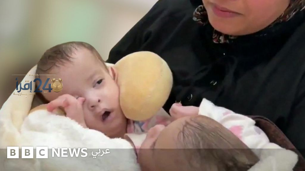 رؤية التوأم السيامي المغربي يحقق حلمه الكبير بالانفصال والبدء بحياة جديدة على سريرين في السعودية